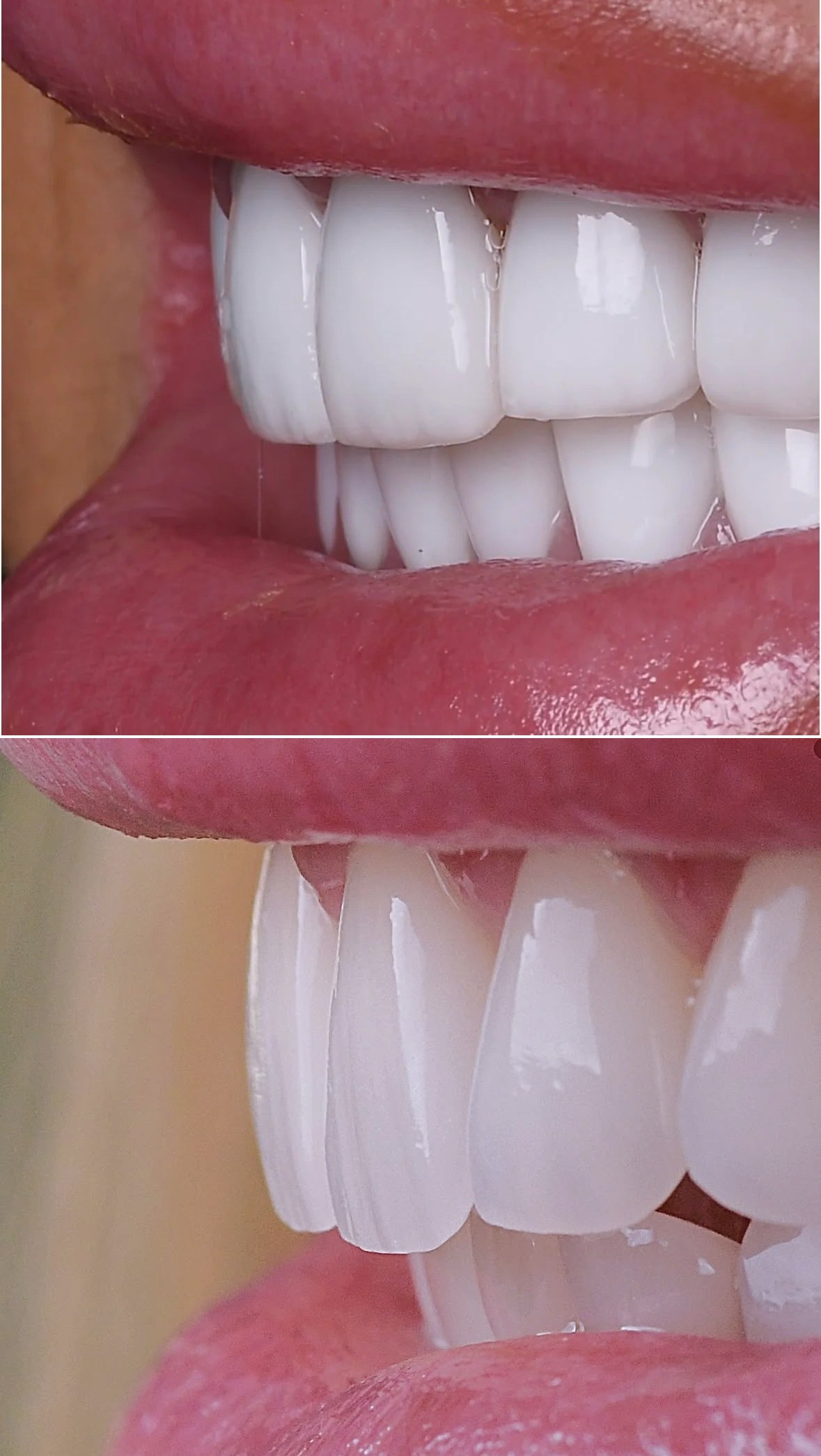 Full transformation: before treatment, aging, bulky, opaque veneers created an unnatural appearance and lacked the beauty and vitality of natural teeth; after treatment, custom ceramic restorations were crafted to mimic the translucency, texture, and vitality of healthy natural teeth.